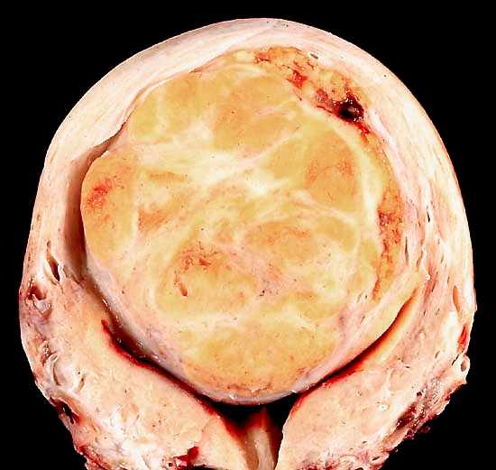 Leiomyom Uterus